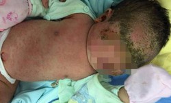 Trẻ 1 tháng tuổi viêm da chảy mủ toàn thân vì tắm lá chữa mụn nhọt